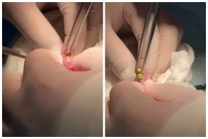 Үш жасар баланың асқазанынан 16 магнит шықты