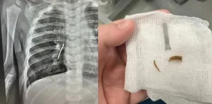 11 айлық баланың өкпесінен шемішкенің қабығы табылды