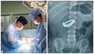 1 жасар баланың ішінен 31 магнит алынды