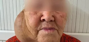 10 жыл бойы асқынған ісік: Алматы дәрігерлерінің сәтті операциясы